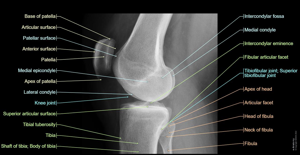 Knee joint - Radiographs (Lateral view) :Patella, Medial condyle, Lateral condyle