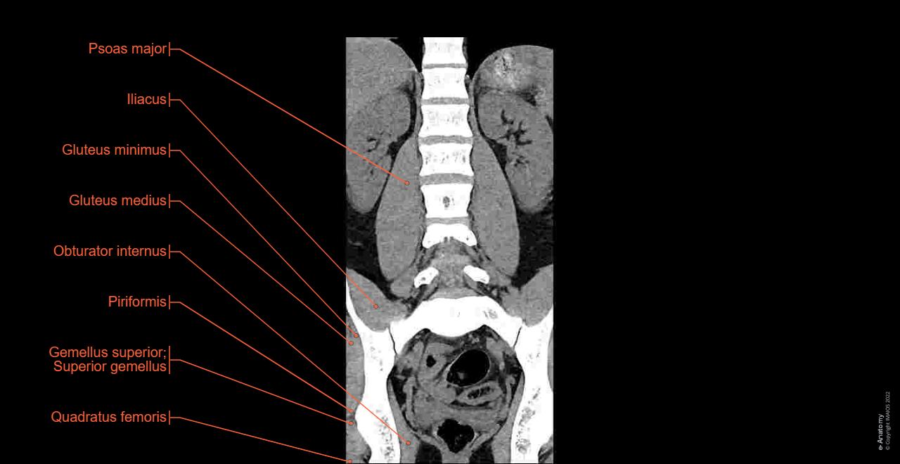CT scan of lumbar spine