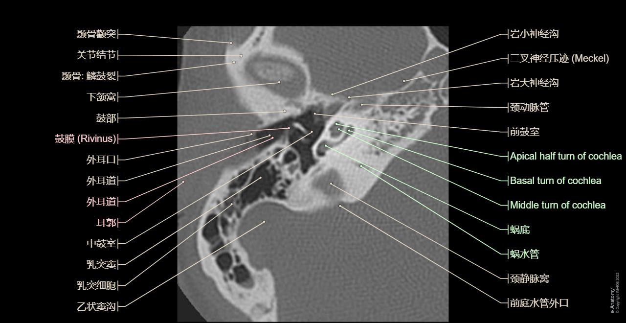 颞骨岩部 CT: 正常解剖 | e-Anatomy
