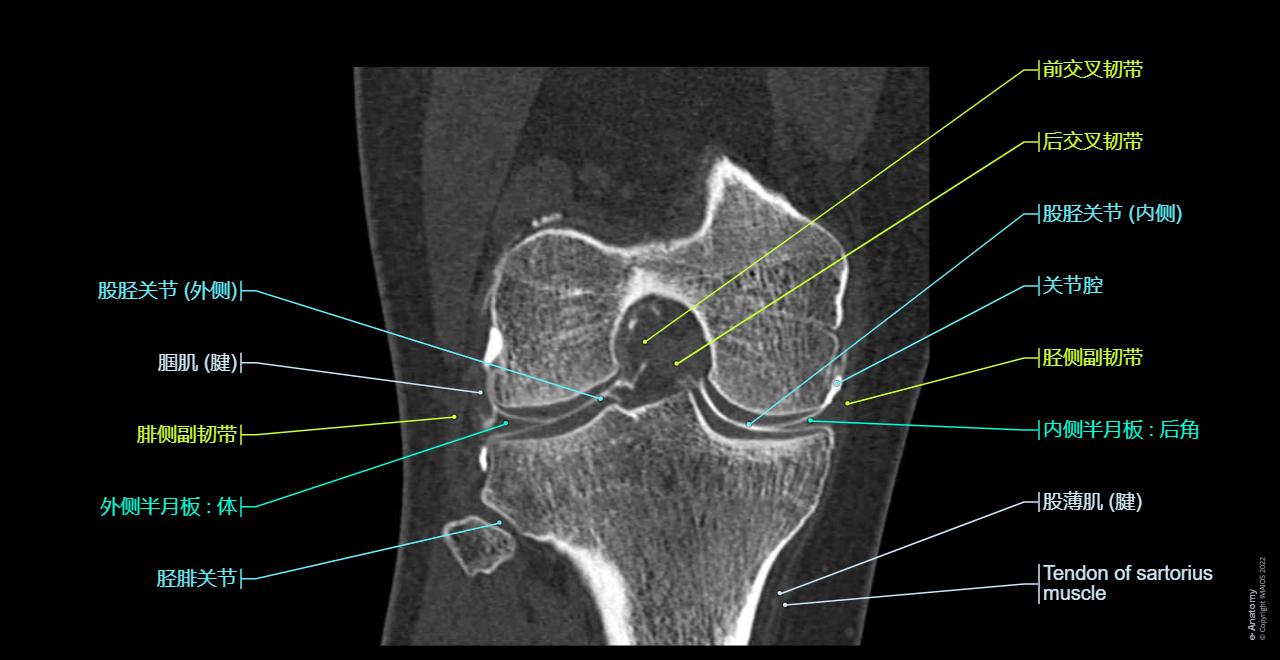 Knee joint - CT arthrogram: Knee joint, Lateral meniscus, Fibular collateral ligament, Tibial collateral ligament