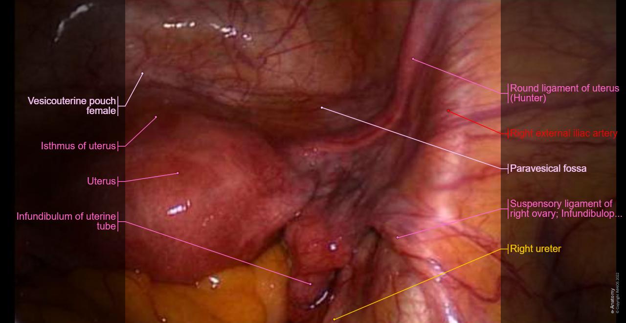 Surgical anatomy of the female pelvis by laparoscopy