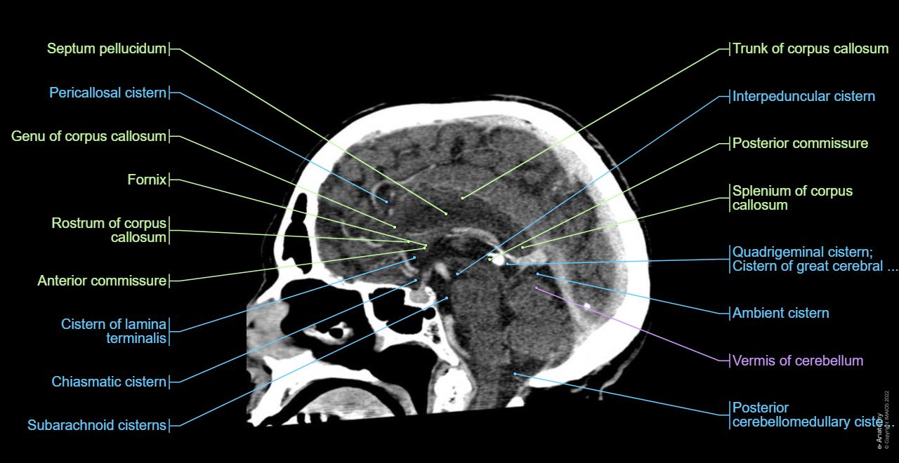 Sagittal, CT, Head, Corpus callosum, Subarachnoid cisterns