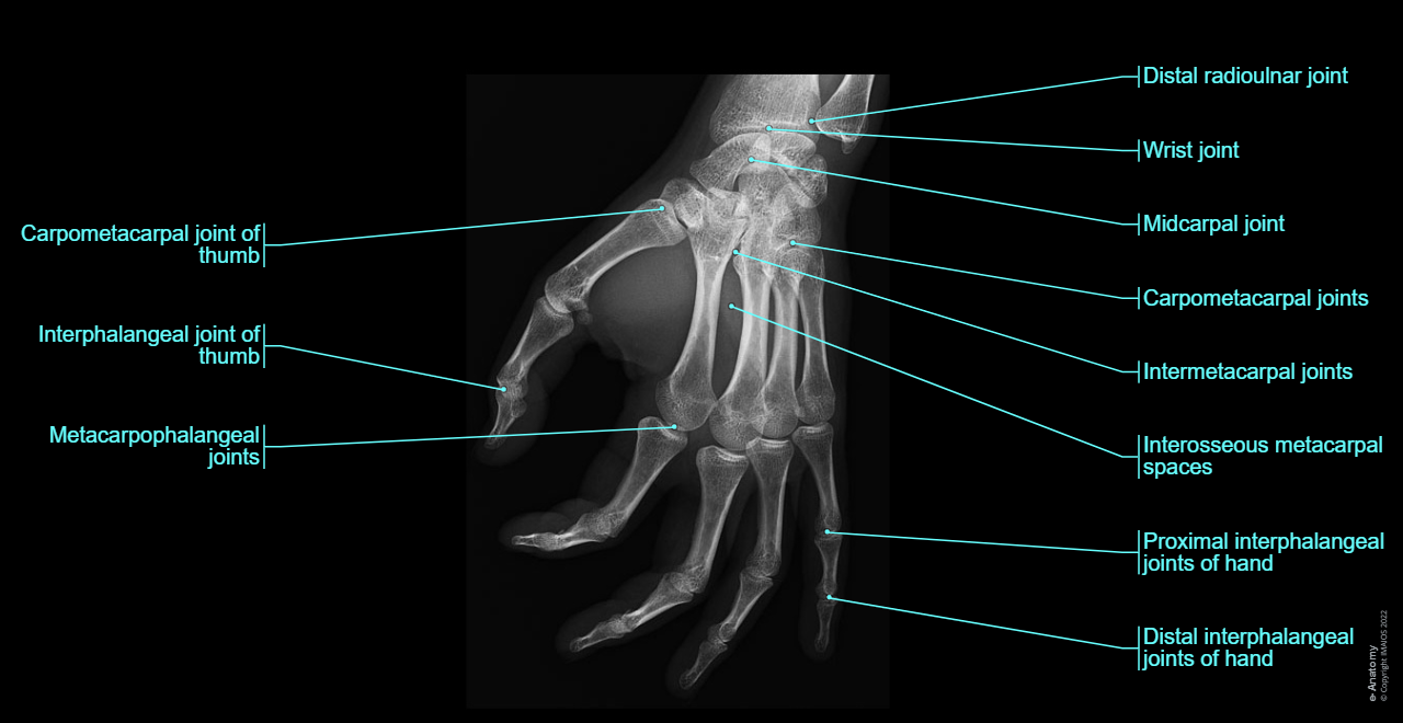 Radiographs - Hand - Digiti manus : Metacarpals [I -V],  Digital bones; Phalanges,  Proximal phalanx,  Middle phalanx,  Distal phalanx,  Sesamoid bones, Carpometacarpal joints,  Intermetacarpal joints,  Metacarpophalangeal joints,  Interphalangeal joints of hand