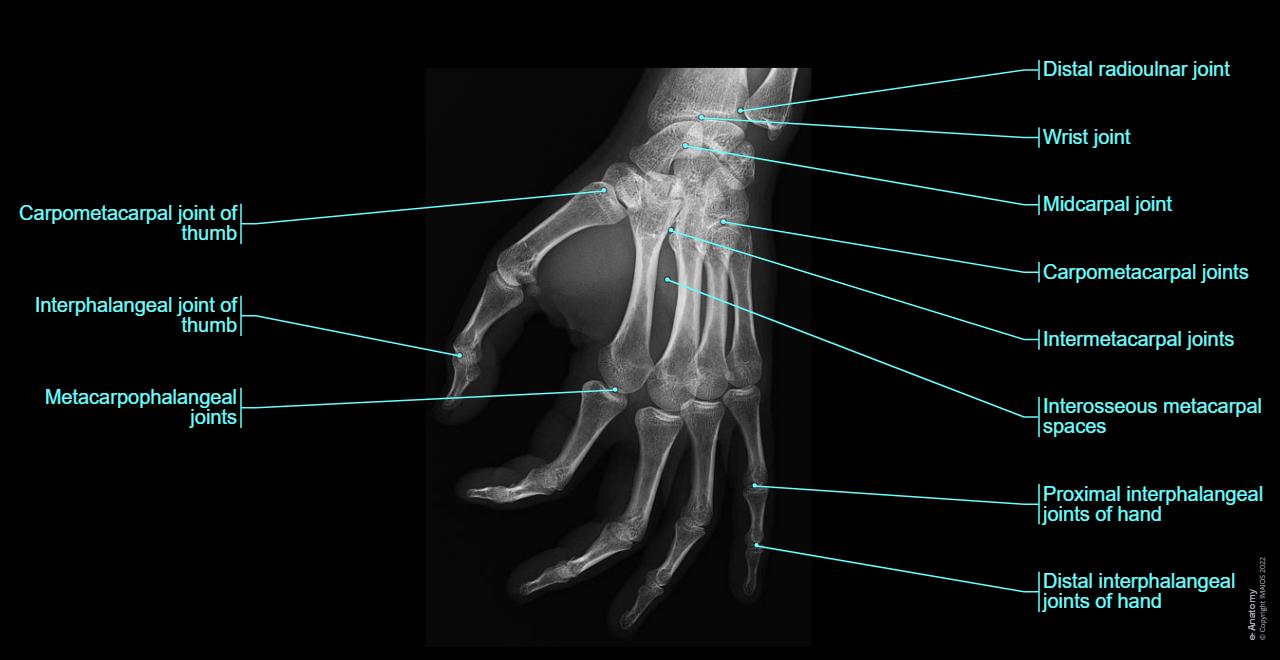 Radiological anatomy of the upper limb : normal anatomy | e-Anatomy