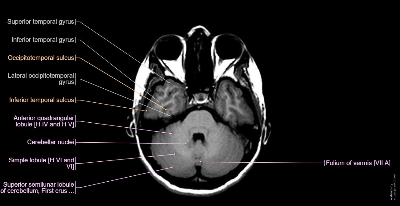 Anatomy of the brain: axial slice T1 weighted
