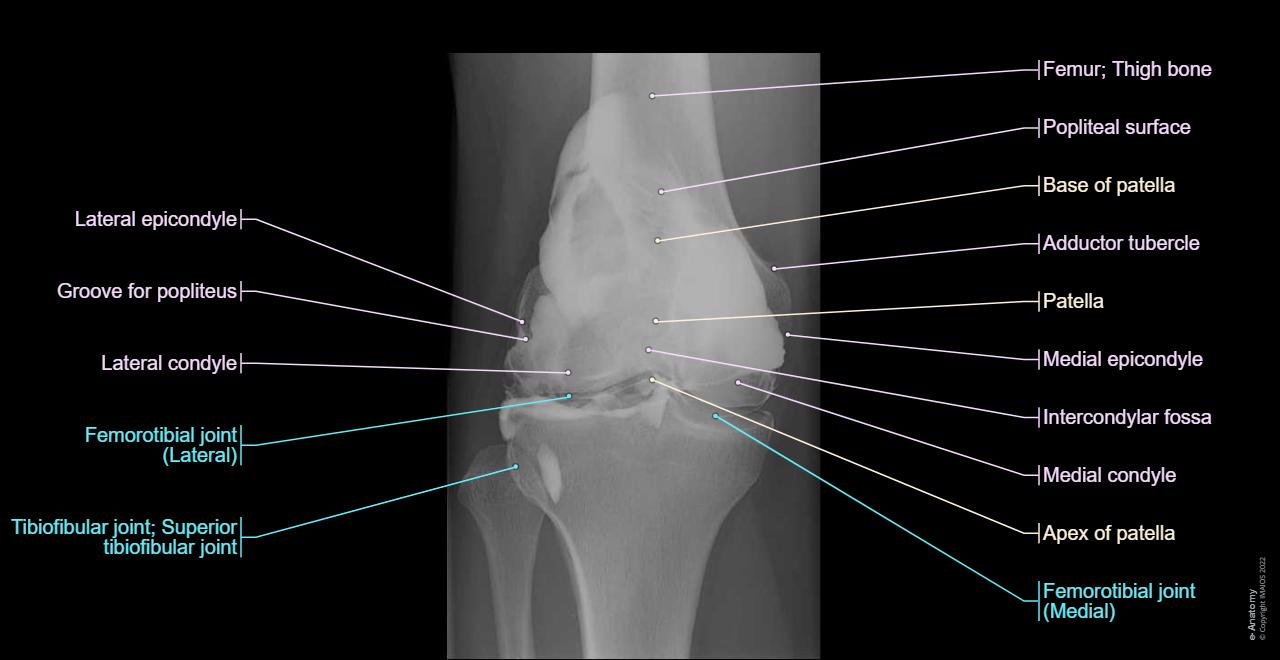 Knee joint: Arthrogram (Arthrogram)