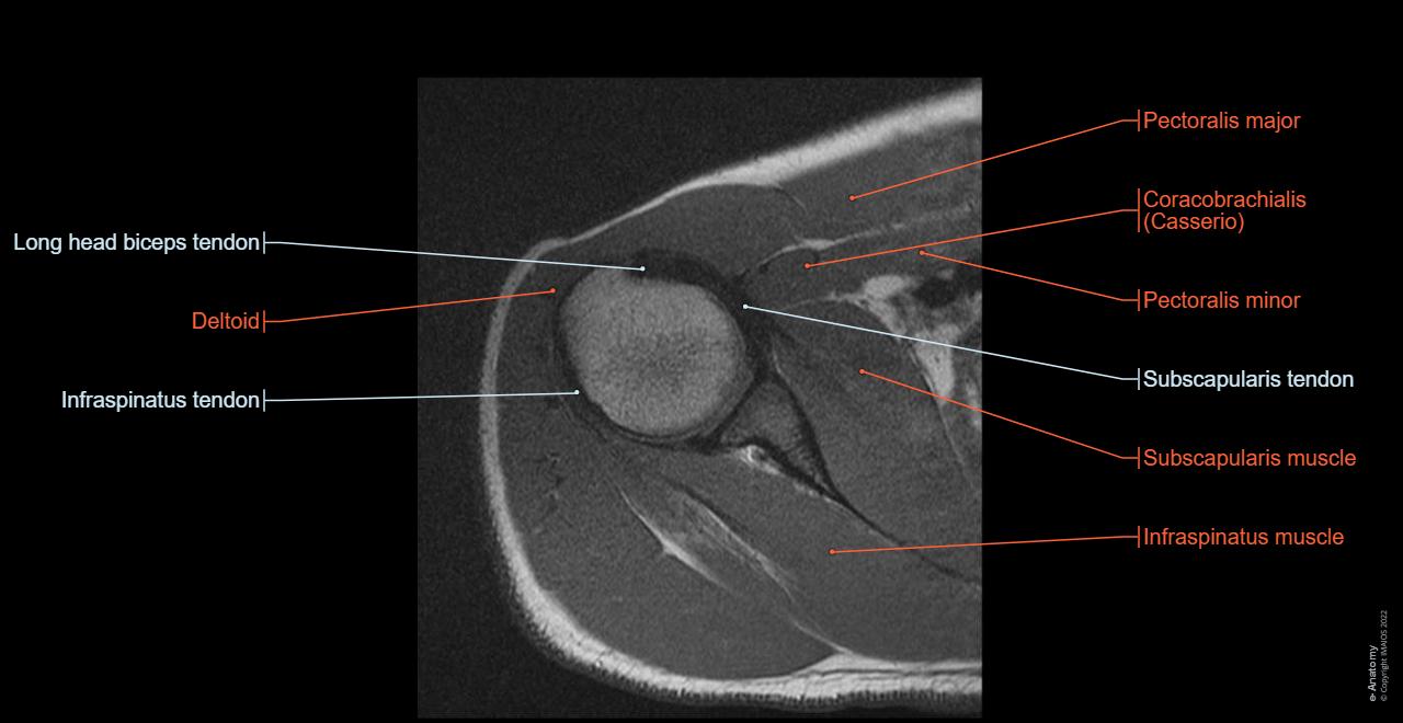 Anatomy of the upper limb : axial slice of the shouler and axillary fossa.