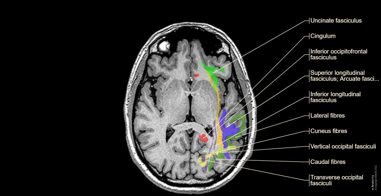 Brain - White matter: Association fibres of telencephalon, Superior longitudinal fasciculus; Arcuate fasciculus