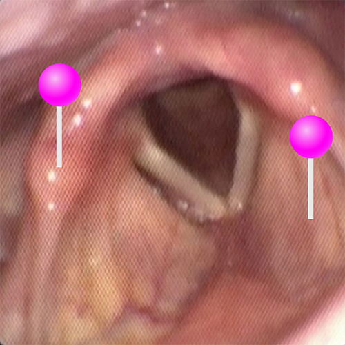 Normal Larynx Anatomy of the nasal cavity, pharynx and larynx: endoscopic view - e ...