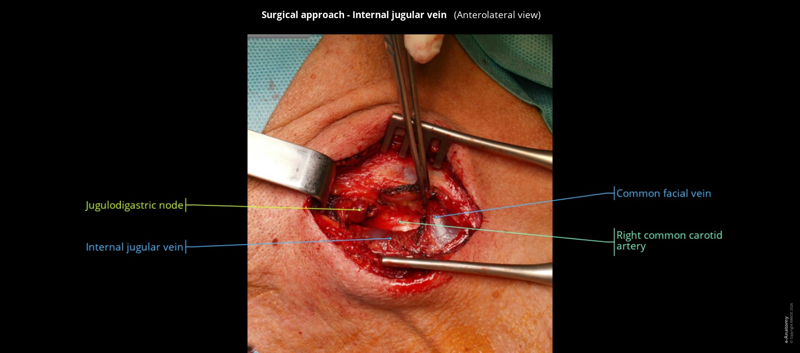 Photograph of the carotid surgical approach in humans: internal jugular vein