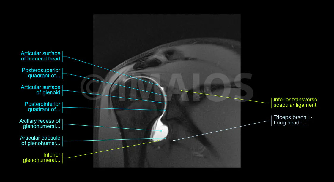 Shoulder MR arthrogram on coronal F1 FS showing the anatomy of the normal glenohumeral joint and of the rotator cuff