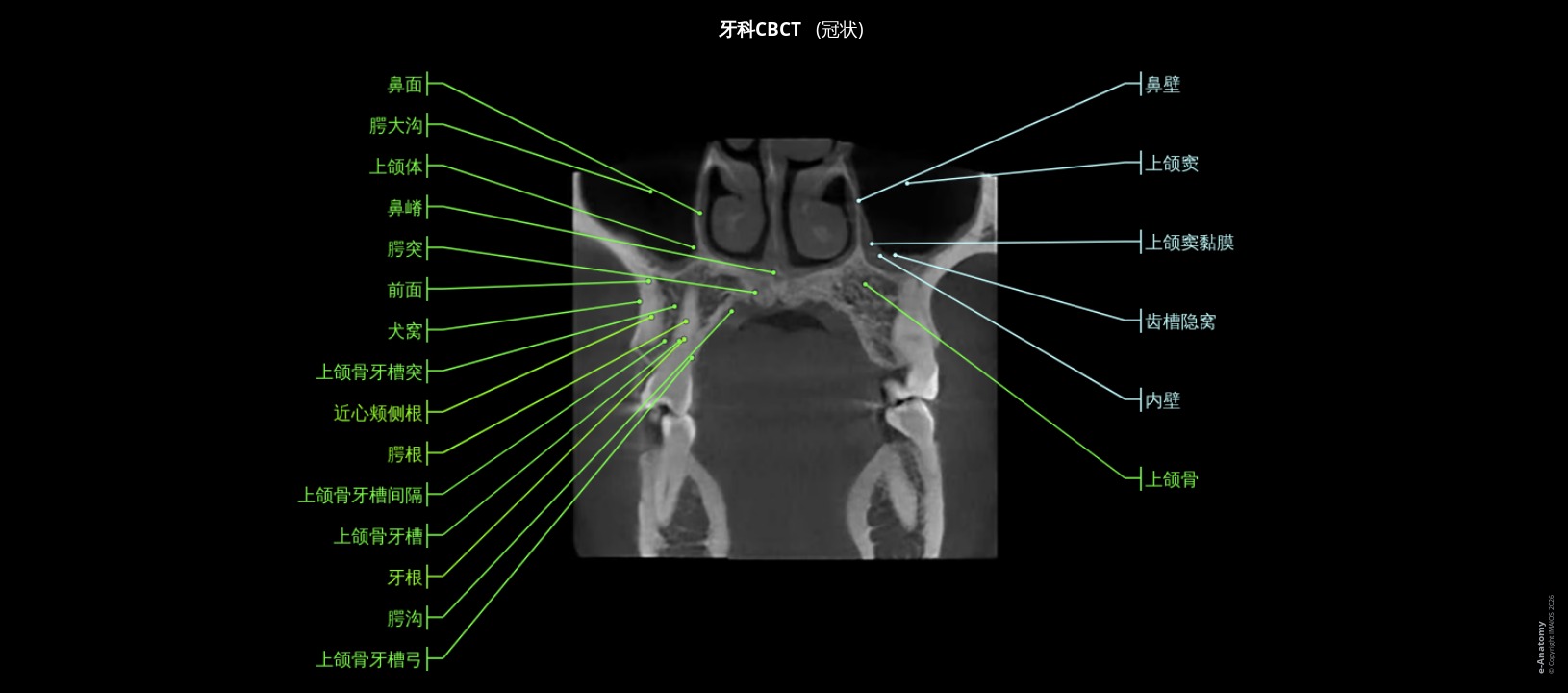人类牙齿锥形束CT（CBCT）解剖图谱：上颌窦冠状切面