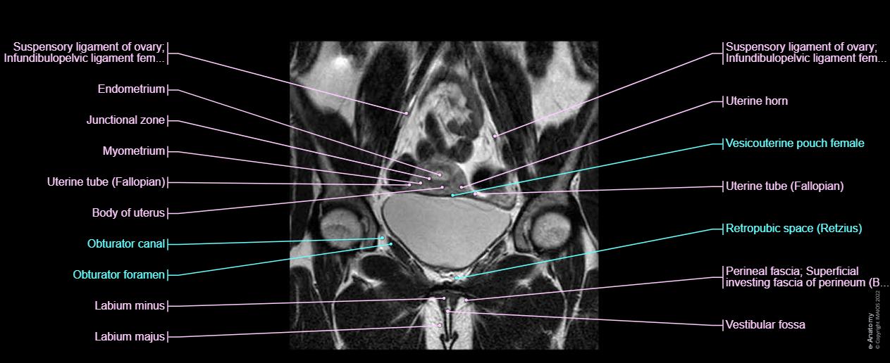 Femal pelvis region anatomy : anatomical structures on a coronal slice magnetic resonance imaging.