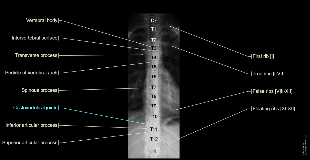 [UMLS:C0012249] - Vertebral column - Thoracic vertebrae [TI-TXII] : Anterior-posterior view - Rib, Costovertebral joints, True ribs [I-VII]