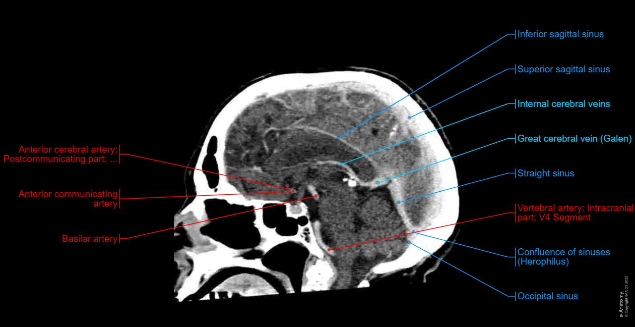 Dural venous sinuses, Superior sagittal sinus, Straight sinus, Great cerebral vein, Basilar artery