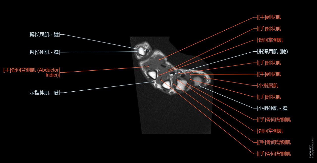 Anatomy of the hand : axial slice of MRI (Magnetic Resonance Imaging) wtith anatomical structures labeled.