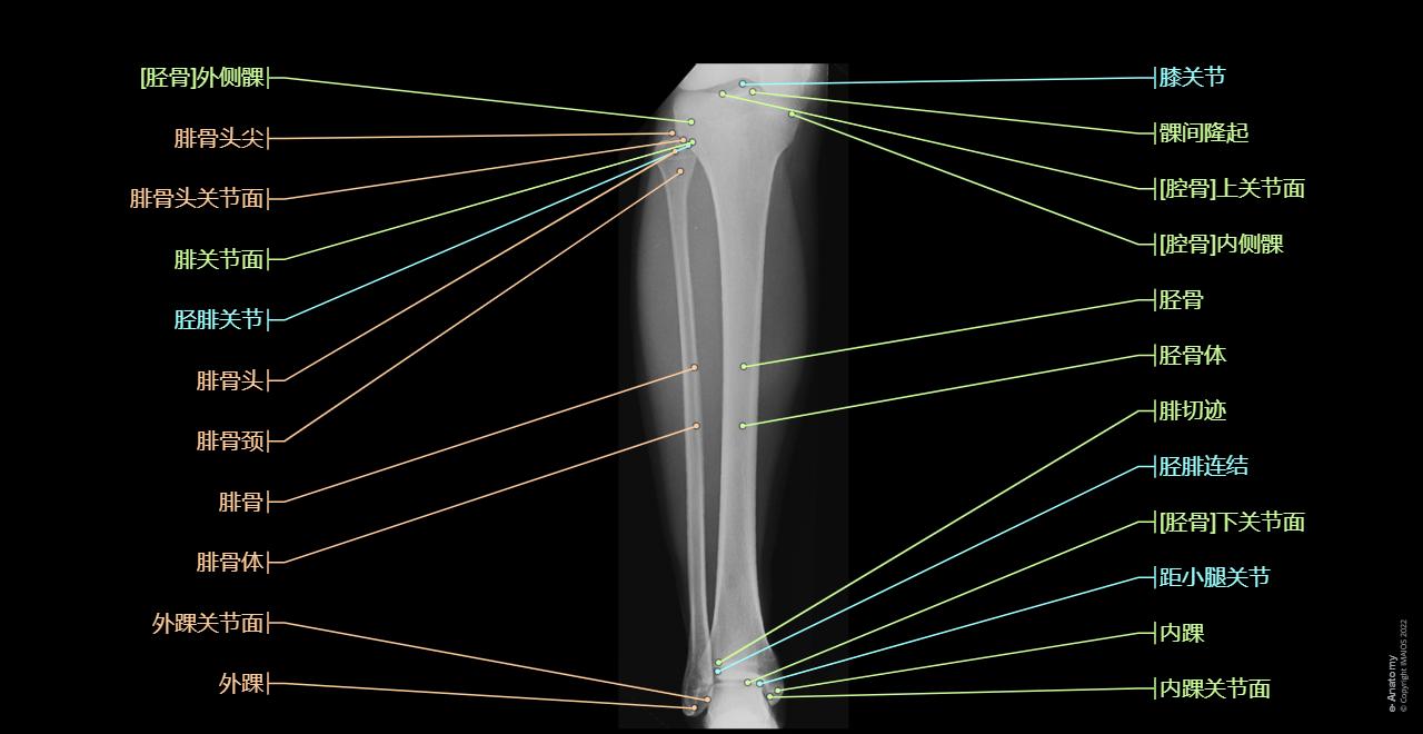 Leg - Radiograph: Tibia, Fibula