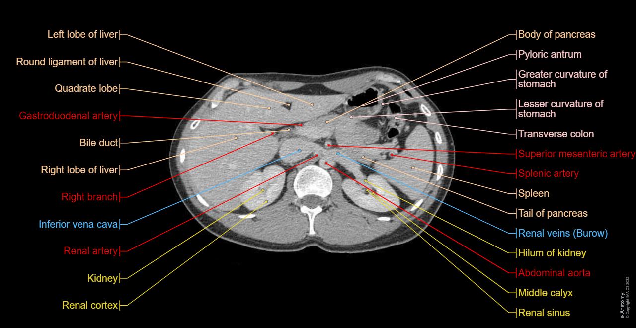 Anatomy of the abdomen based on MDCT : axial slice showing liver, kidney, spleen, jejunum, colon, pancreas, stomach, mesenteric vein, splenic artery...