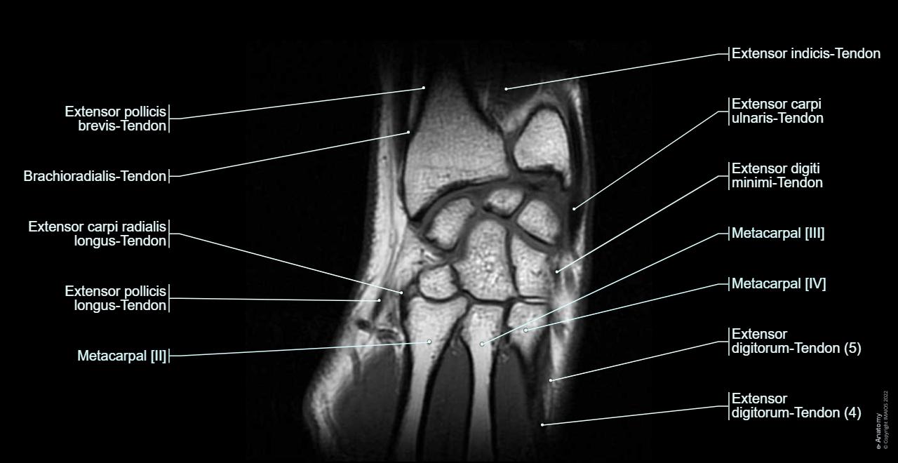 Anatomy of the wrist on 3T MR (axial, sagittal and coronal slices) and 3D views of the carpal bones : Wrist joint, Midcarpal joint, Carpometacarpal joints