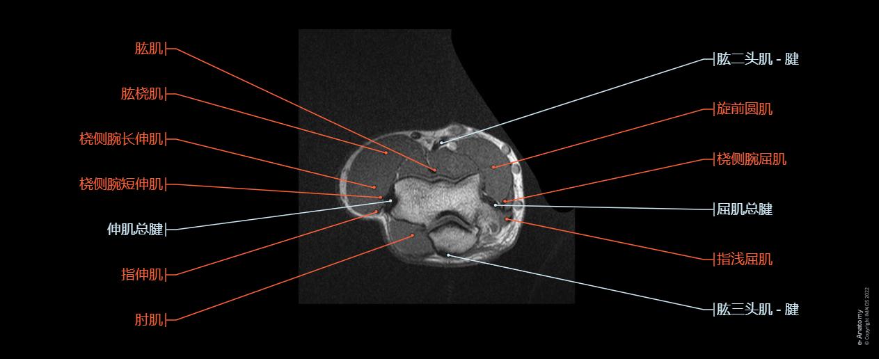 Human anatomy of the bend : bones (capitulum, trochlea, medial and lateral epicondyle, olecranon), common extensor and flexor tendon, nerves (radial, median , ulnar), cephalic and basilic veins...