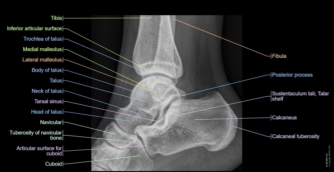 Talus - Calcaneus (-Lateral view) :Neck of talus, Sustentaculum tali; Talar shelf, Tarsal sinus, Fibular trochlea; Peroneal trochlea; Peroneal tubercle