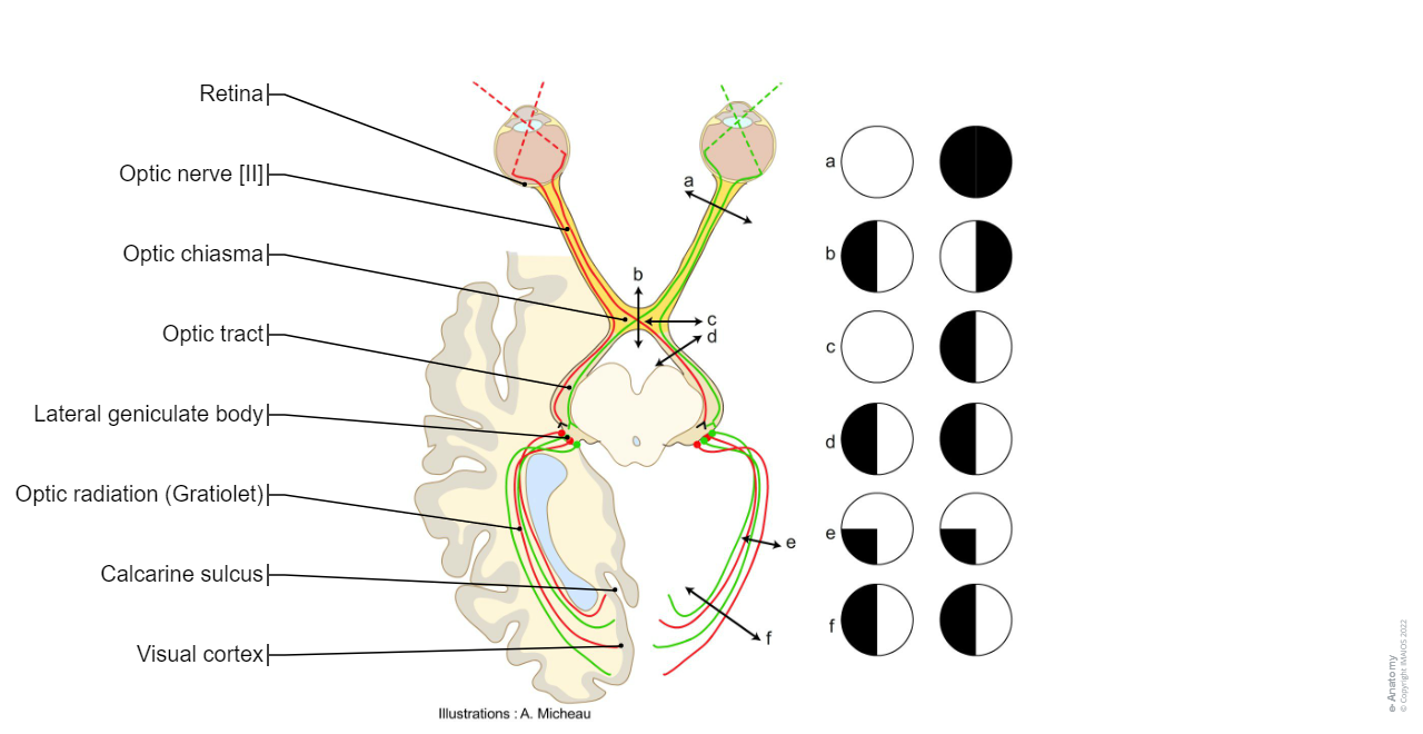 Optic nerve [II] - Schematic Human anatomy : Retina, Optic chiasma,  Optic tract, Lateral geniculate body, Optic radiation, Visual cortex, [UMLS:C0271202], [UMLS:C0271208], [UMLS:C0544680], [UMLS:C0750958], [UMLS:C0155320]