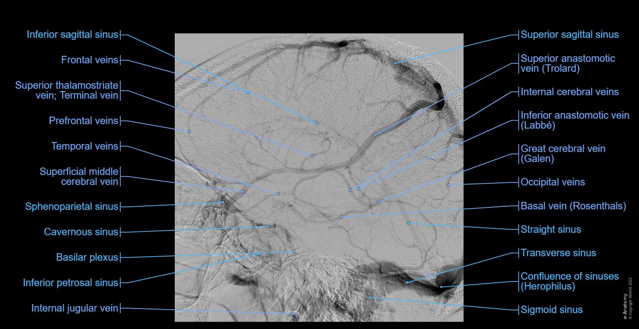 Dural venous sinuses - Cerebral veins: Angiography - Lateral view