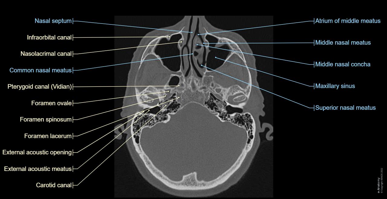 Cranial base - CT: Foramina, Nasal cavity, Paranasal sinuses, Sphenoidal sinus, Middle nasal concha