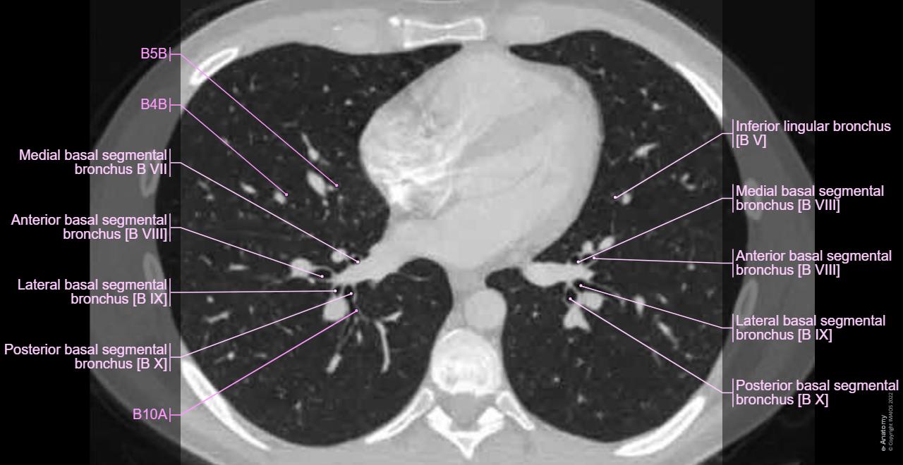 Bronchopulmonary segments - Thorax (CT) : Superior lobe; Upper lobe Lingula of left lung Middle lobe of right lung Inferior lobe; Lower lobe Oblique fissure Horizontal fissure of right lung