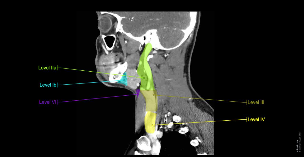 CT scan of head and neck