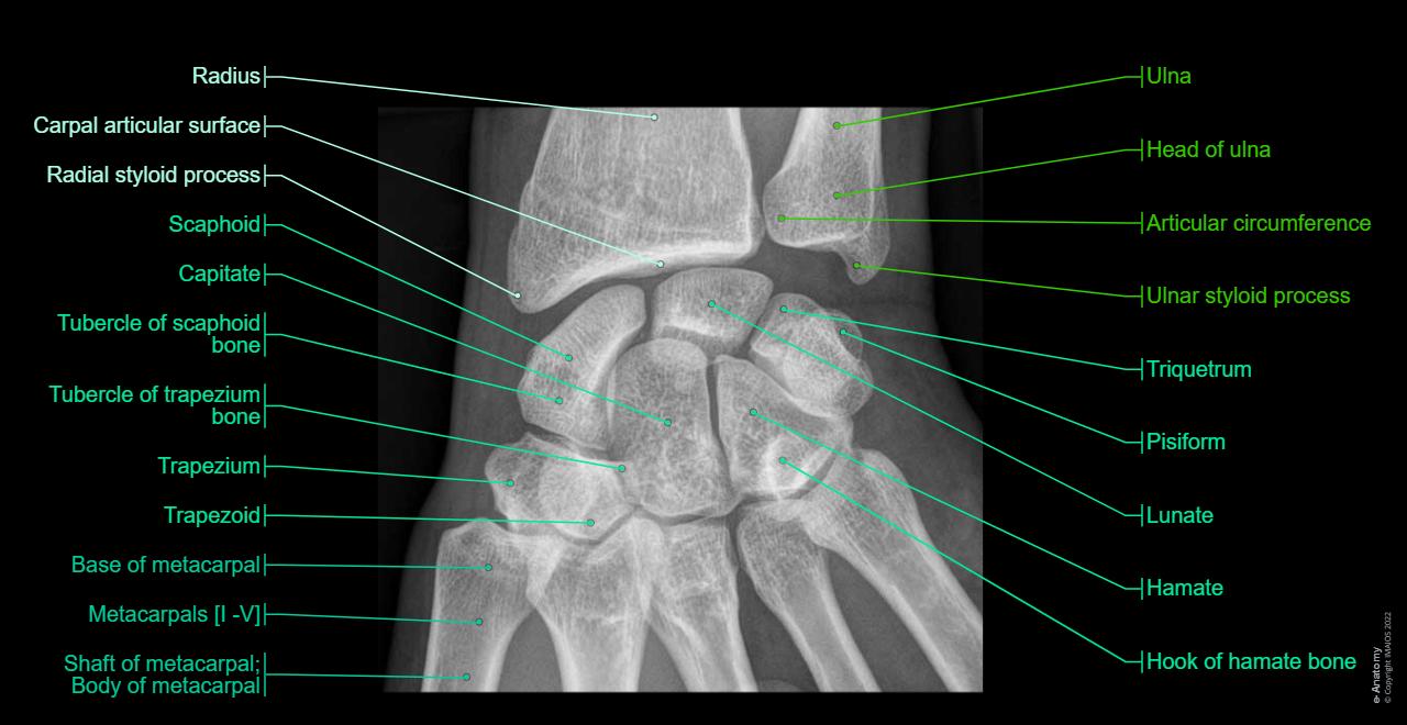 Anatomy atlas - Radiographs - Wrist : Scaphoid, Tubercle, Lunate, Triquetrum, Pisiform, Trapezium, Tubercle, Trapezoid, Capitate, Hamate, Distal radioulnar joint, Wrist joint, Carpal joints; Intercarpal joints, Midcarpal joint, Pisiform joint, Carpometacarpal joints