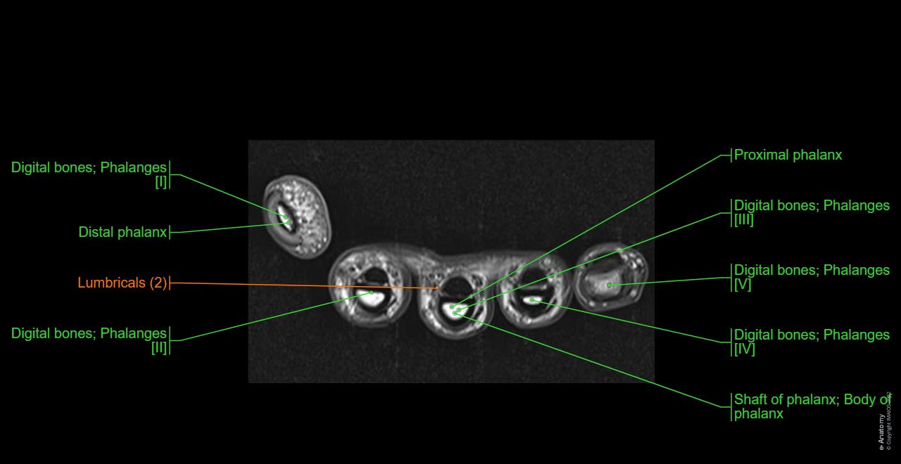Human anatomy, MRI, Fingers including thumb, Flexor digitorum profundus, Tendons