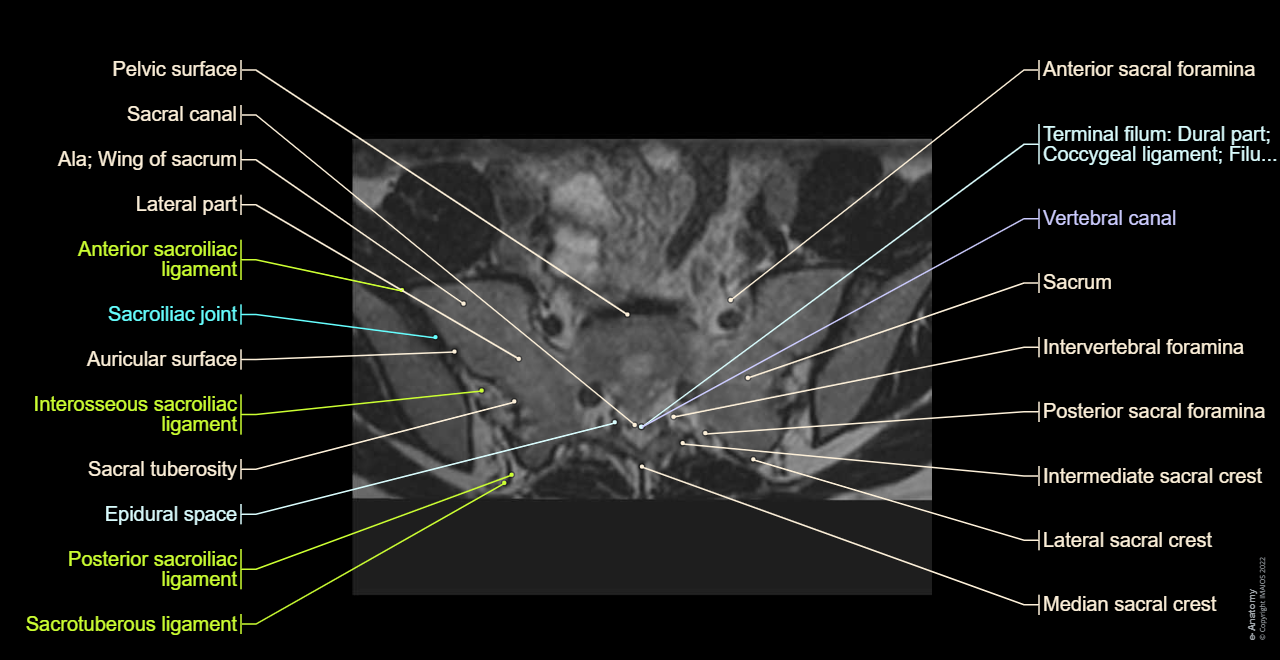 Sacrum [sacral vertebrae I - V]: Axial cross section - MRI