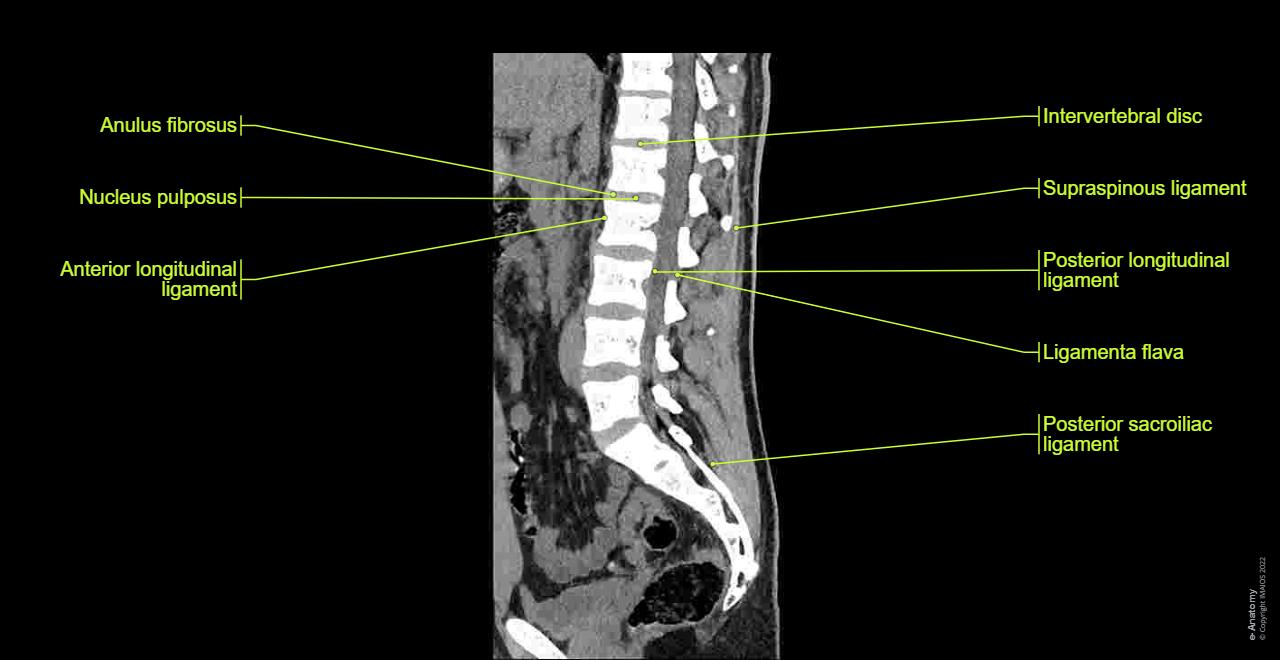 CT scan of lumbar spine