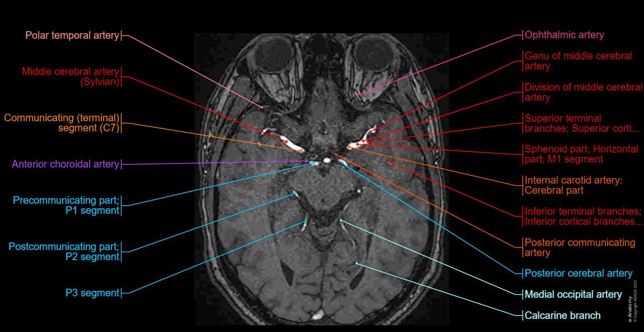 Cerebral arterial circle - MRI: TOF - Axial view
