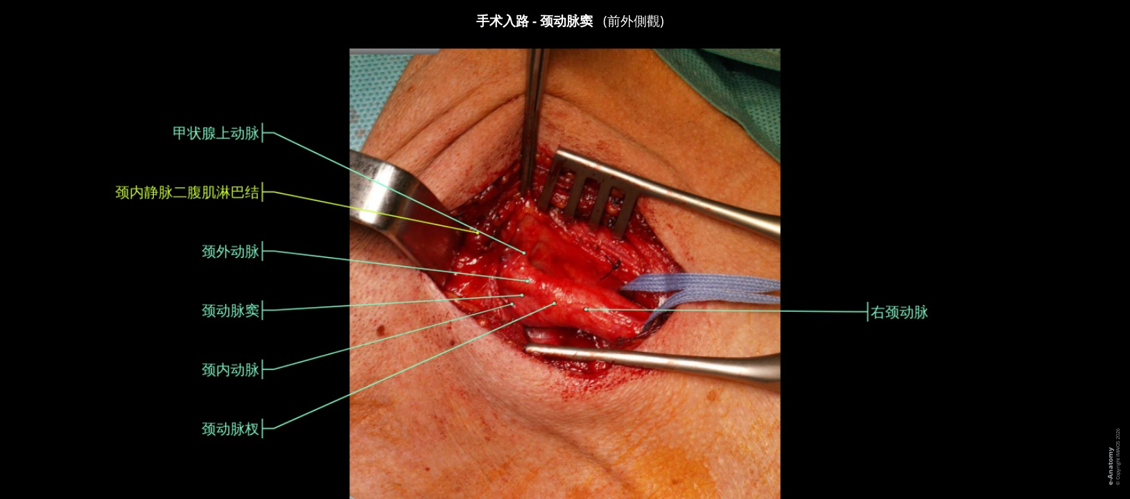 人颈动脉手术标注图像