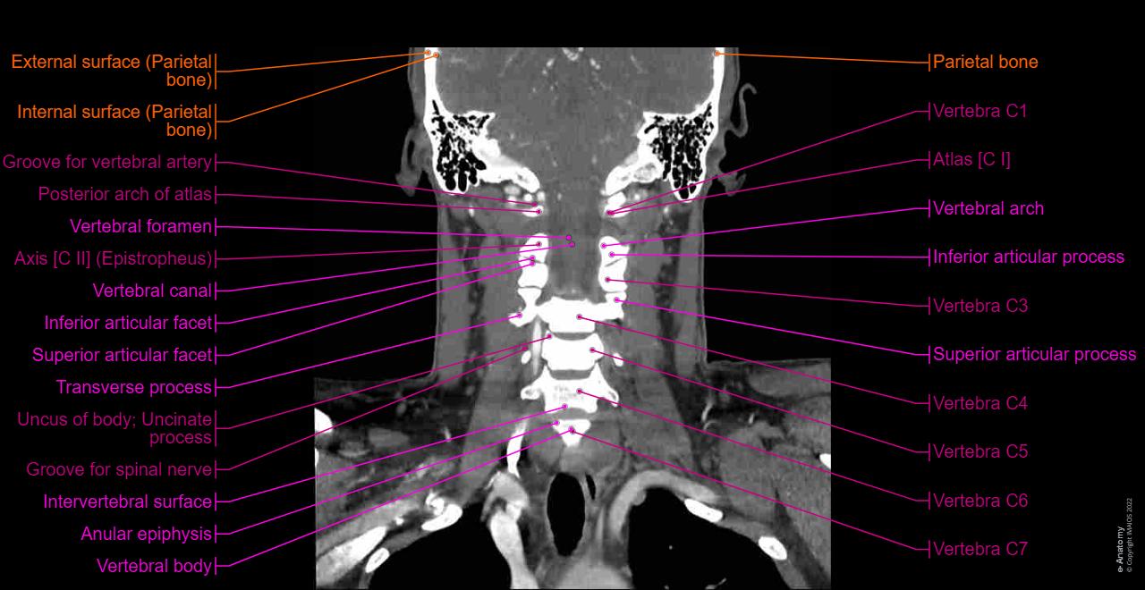 CT scan of head and neck