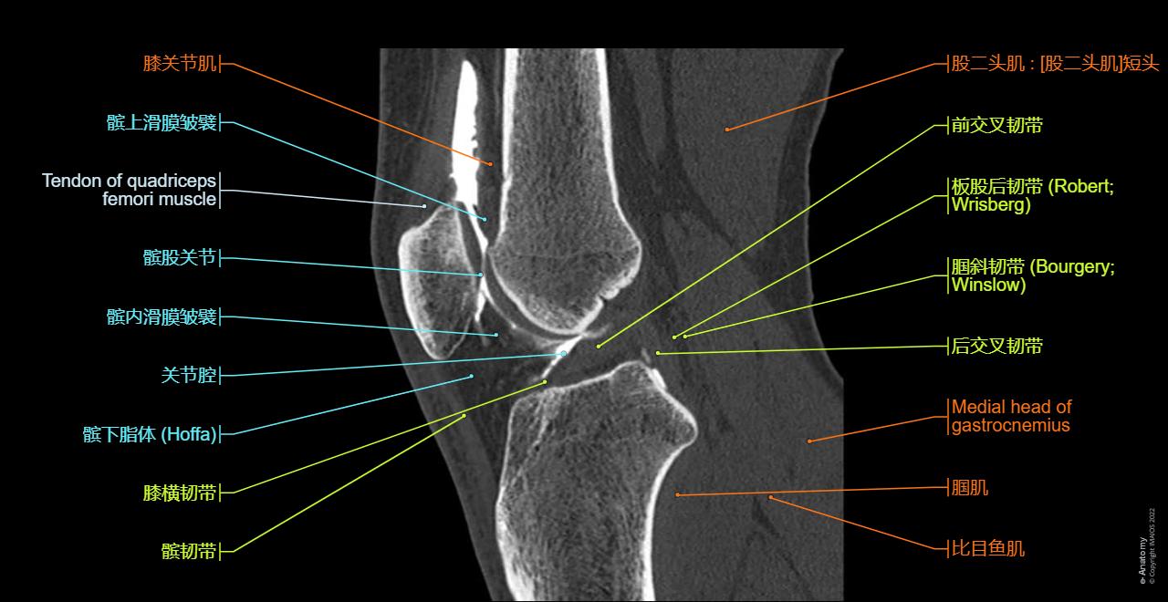 Radiological anatomy of the knee on a CT Arthrogram: Anterior cruciate ligament, Plica synovialis suprapatellaris