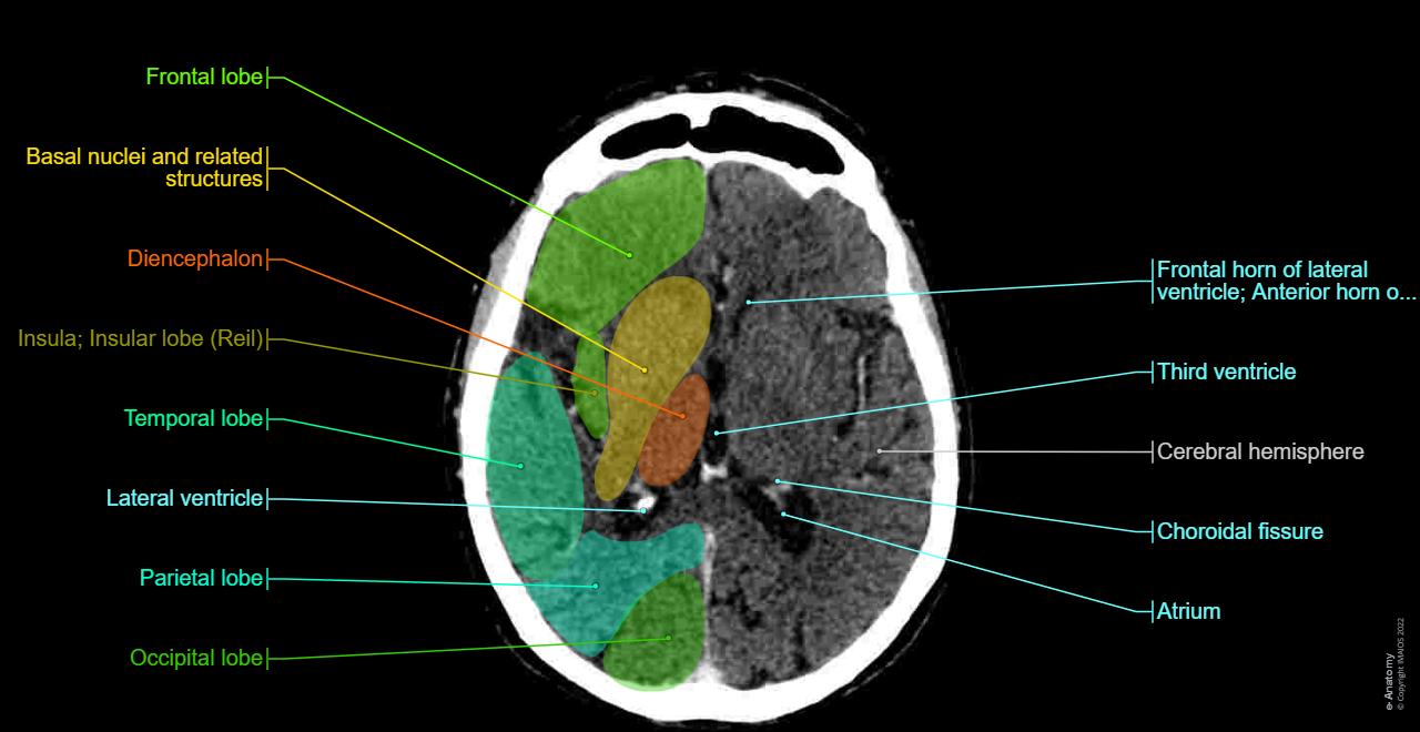 Brain, CT, Anatomy, Cerebral lobes, Ventricles