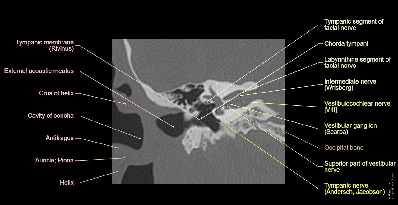 Coronal anatomy of the ear : ossicles, tympanic cavity, bony labyrinth...