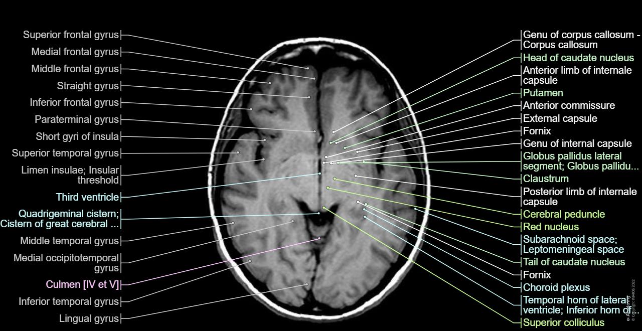 Cross sectional anatomy of the brain: a module based on MRI