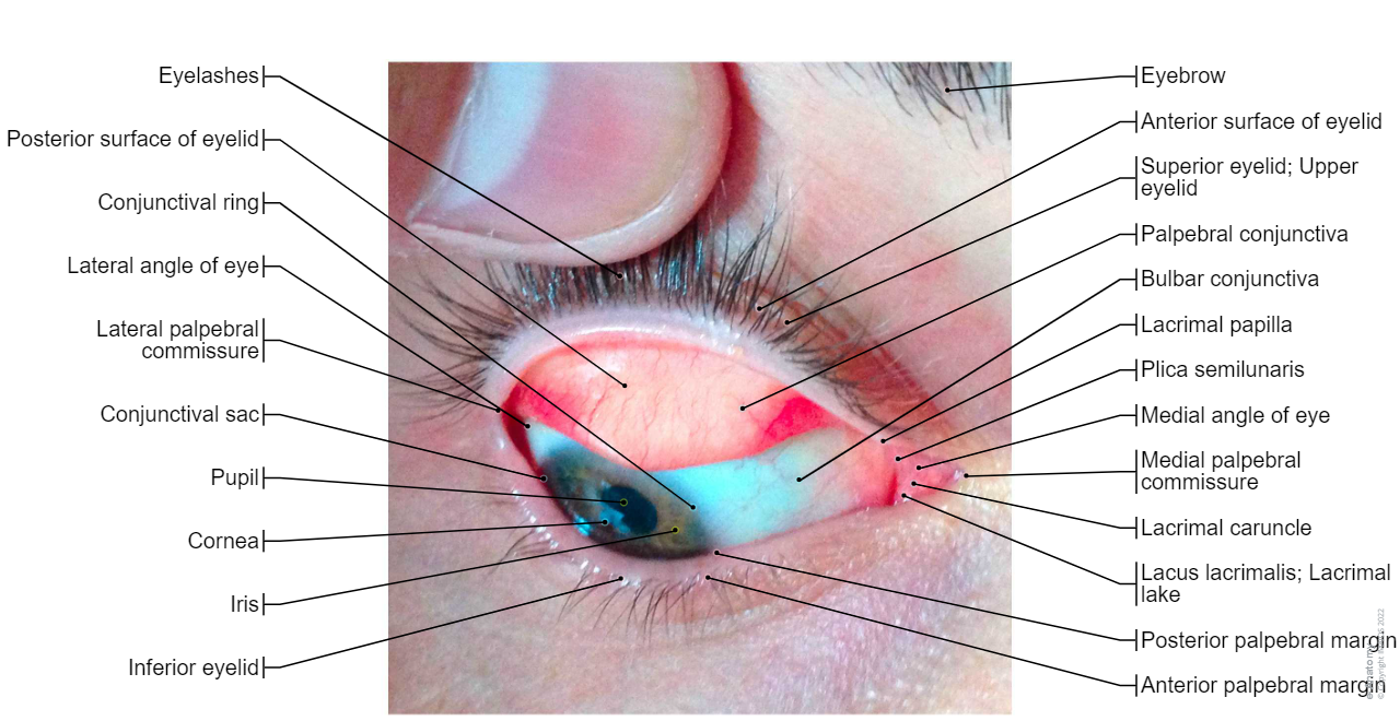 Palpebral conjunctiva-Photos: Superior eyelid; Upper eyelid, Posterior surface of eyelid, Lacrimal caruncle