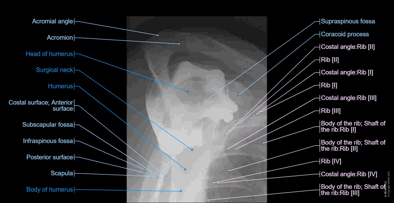 CT arthrogram of the shoulder joint : Acromion, Coracoid process
