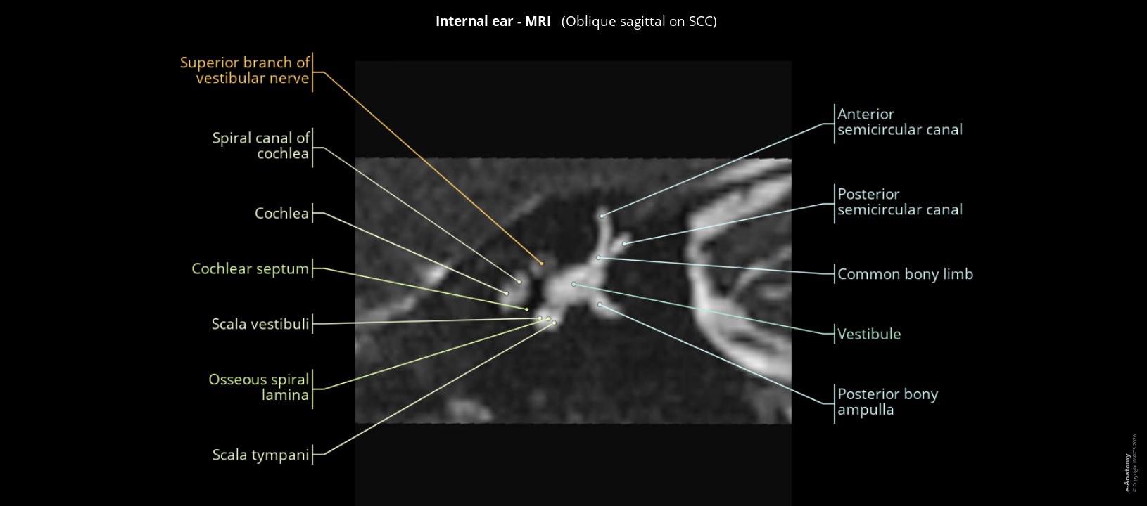 MRI of the human inner ear: oblique sagittal section through the superior semicircular canal