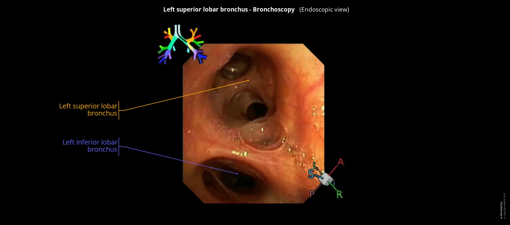 Labelled bronchoscopy in human