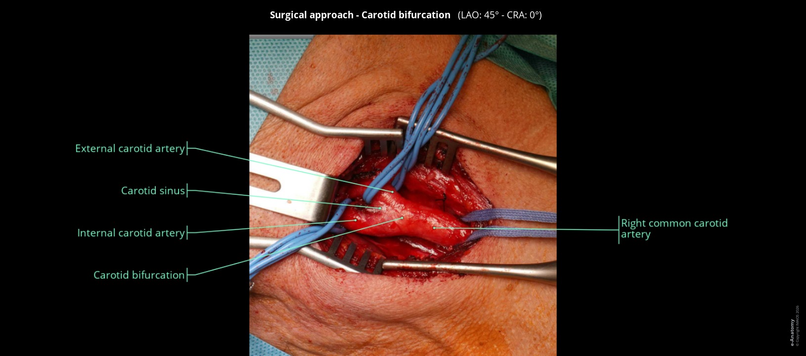 Anatomical atlas of the carotid region: surgical approach in humans