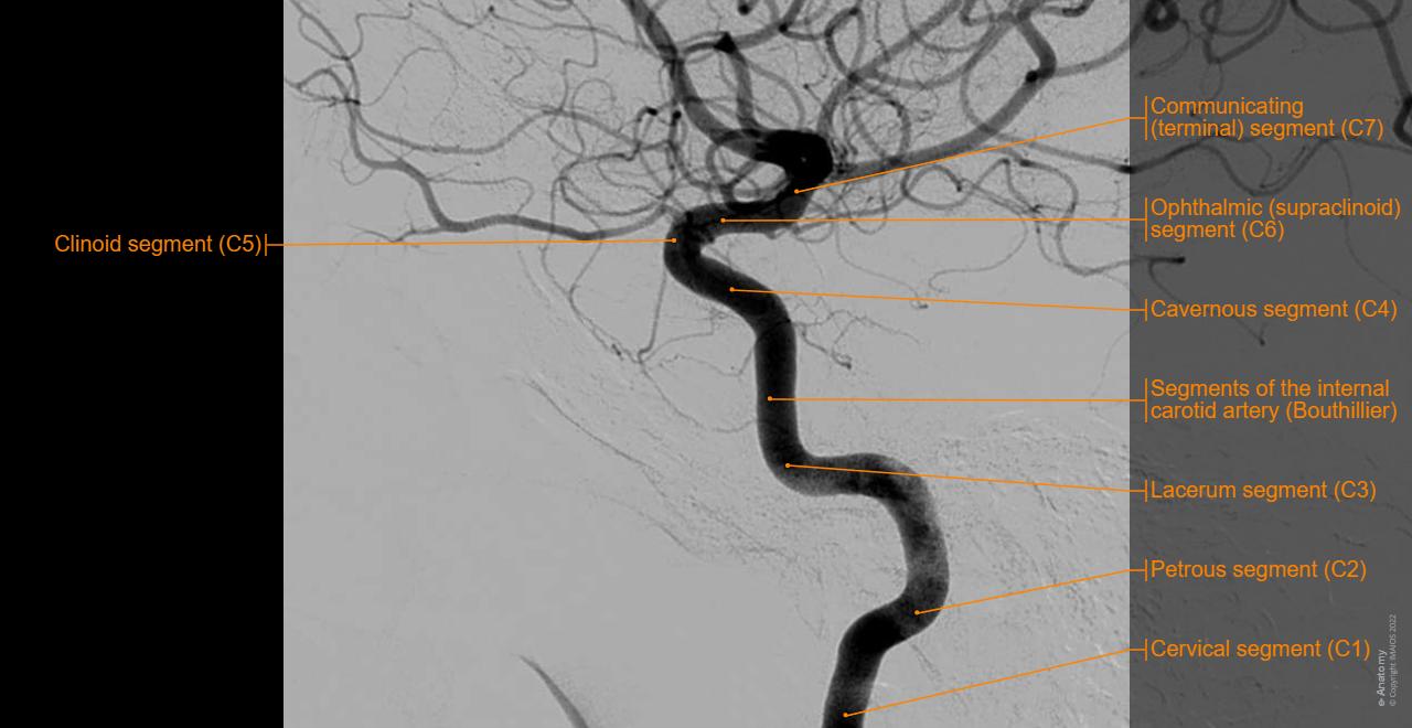 Segments of the internal carotid artery (Bouthillier) - Angiography: Cervical segment (C1), Petrous segment (C2)...