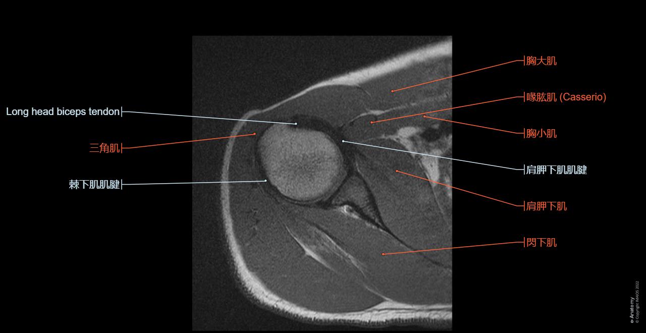 Anatomy of the upper limb : axial slice of the shouler and axillary fossa.