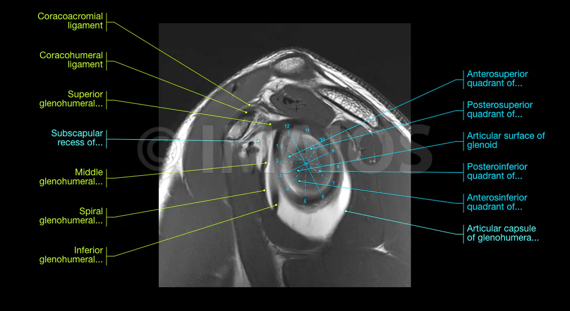 Shoulder MR arthrogram on sagittal T1 showing the articular surface of glenoid, the glenoid labrum, the bicipital-labrum complex and the glenohumeral ligaments