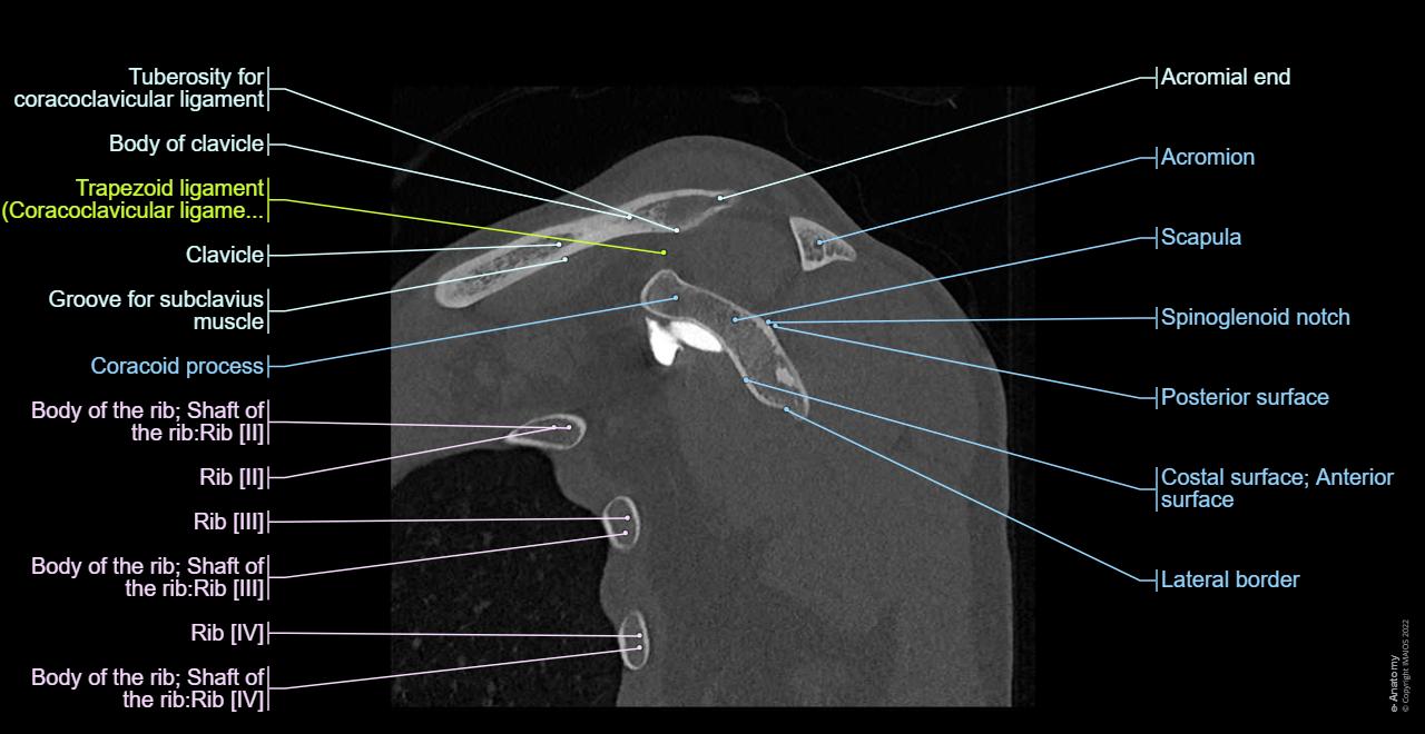 CT arthrogram of the shoulder joint : Glenohumeral ligaments, Scapula